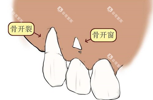 骨开窗卡通示意图