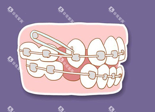 牙齿收缝卡通图片