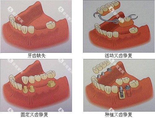 牙齿缺失修复多种方式