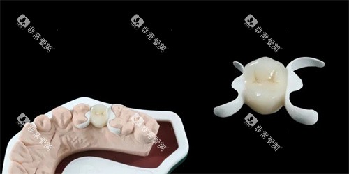 hpp粘接桥义齿实物展示图