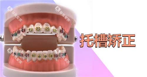 托槽矫正图
