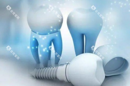 种植体模型图片一览 种植体模型图片一览