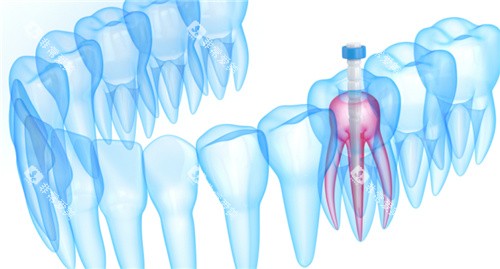 牙齿内部根管透视图 牙齿内部根管透视图
