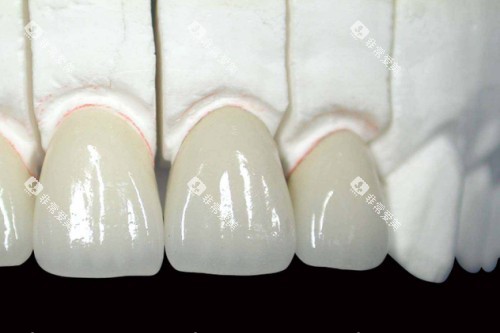 全瓷牙模型图 全瓷牙模型图