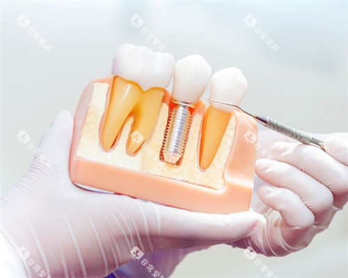 单颗种植牙模型