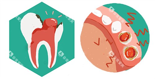 牙齿内息肉动画 牙齿内息肉动画