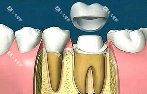 牙冠治疗过程示意图 牙冠治疗过程示意图