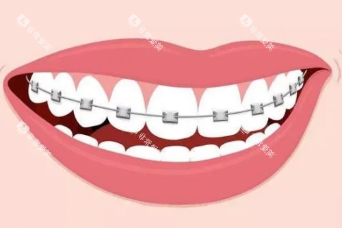 金属矫正卡通图 金属矫正卡通图