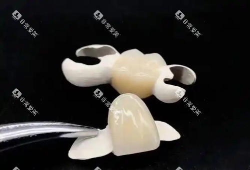 hpp粘接桥牙齿示意图