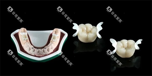 hpp粘接桥义齿模型展示图