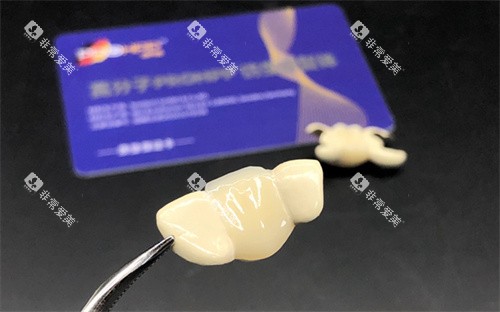 PROHPP聚合瓷粘接桥