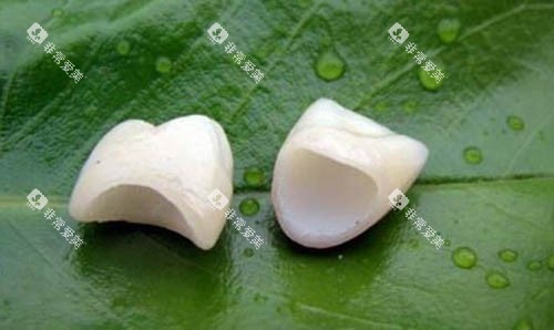 全瓷牙冠照片实物图 全瓷牙冠照片实物图