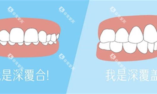 牙齿深覆合展示对比