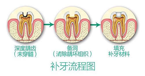 补牙流程