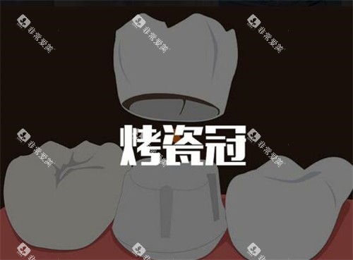 烤瓷牙改善图照片