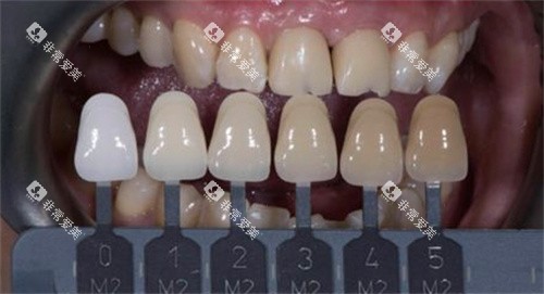 前牙美学修复