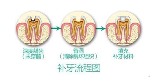 补牙过程图