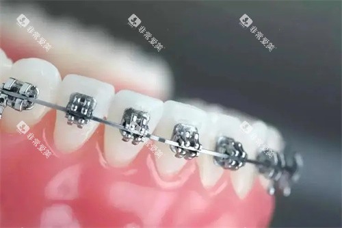 金属自锁托槽矫正