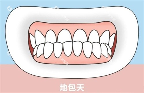 地包天示意图