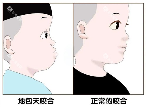 地包天和正常对比图