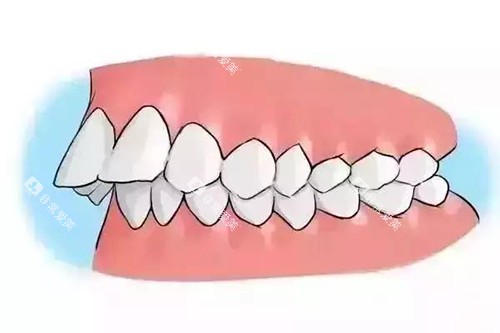 深覆合牙齿突出卡通示意图