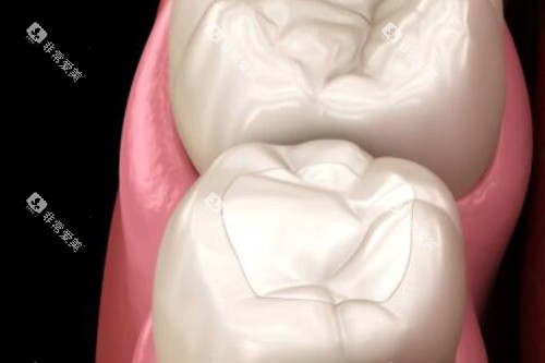 拔牙改善展示照片