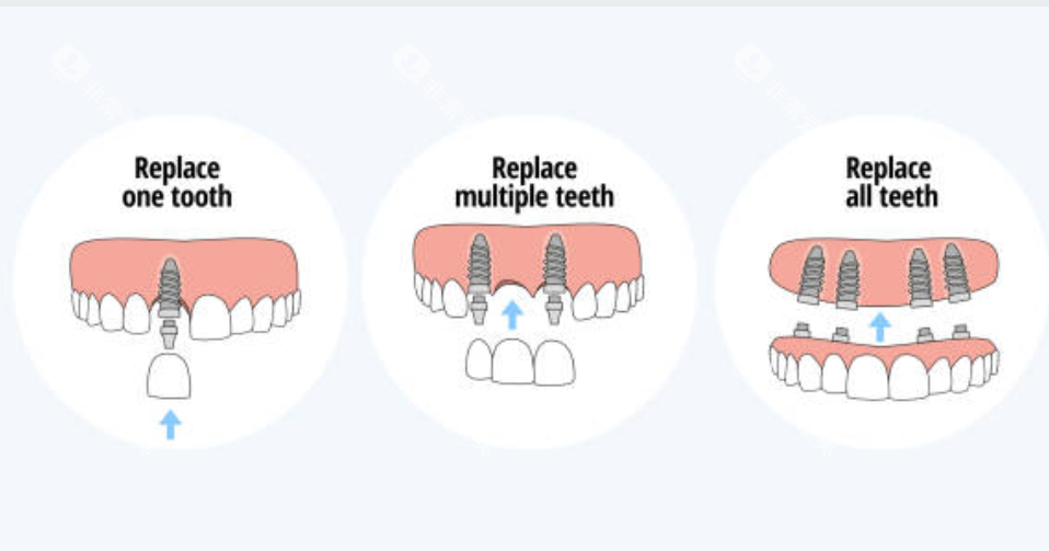 种植牙过程卡通图
