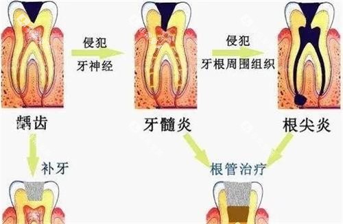 牙髓炎的治疗方法