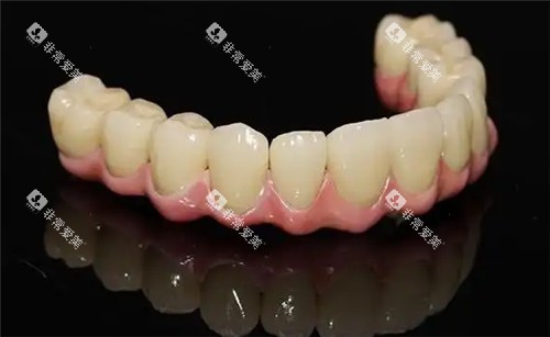 半口假牙套照片 半口假牙套照片