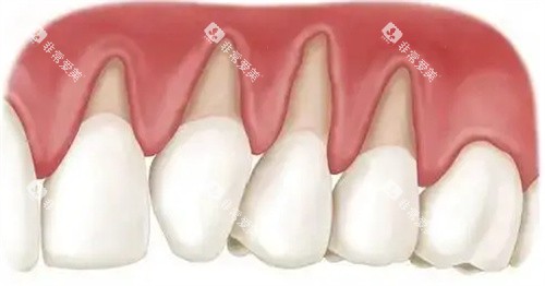 牙龈萎缩卡通图