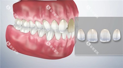 牙齿贴面预想图 牙齿贴面预想图