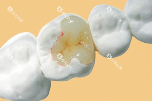 补牙示意图 补牙示意图