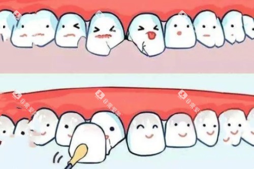 牙贴面卡通图