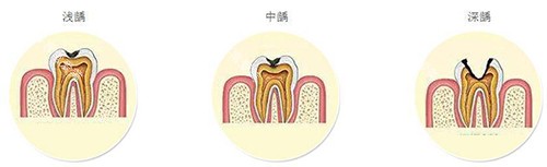 浅龋中龋深龋示意图