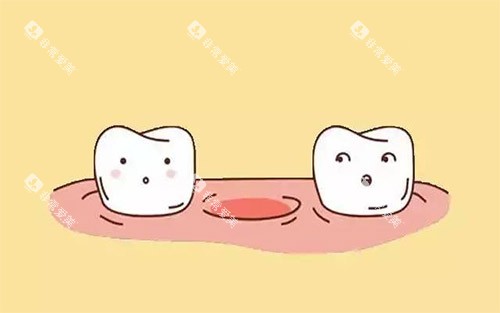 缺牙示意图