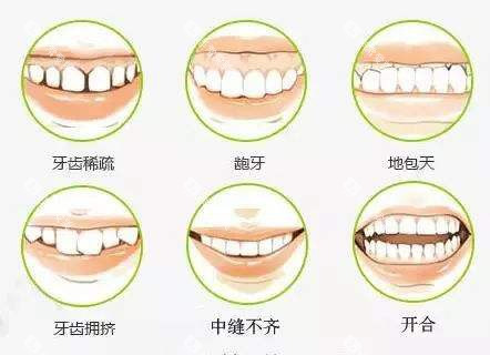 牙齿矫正不同的适应症