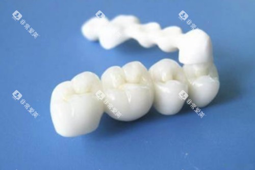 全瓷牙冠模型一览图
