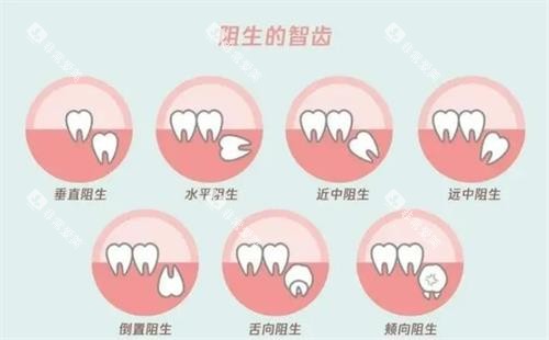 阻生智齿的示意图