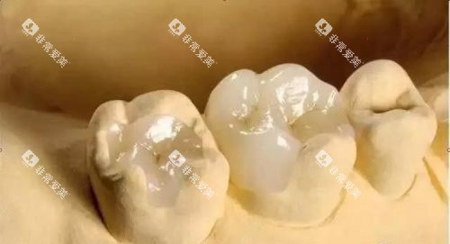 烤瓷牙展示图
