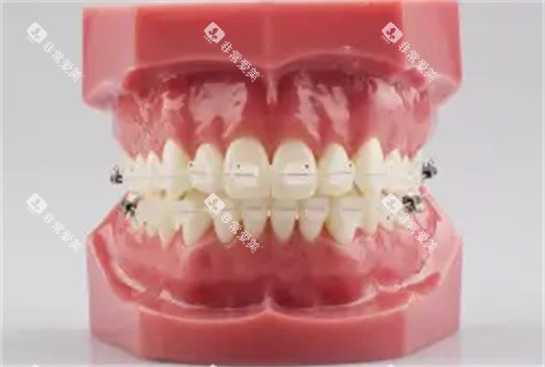 半隐形矫正牙齿模具图