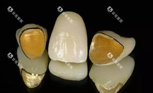 烤瓷牙冠照片