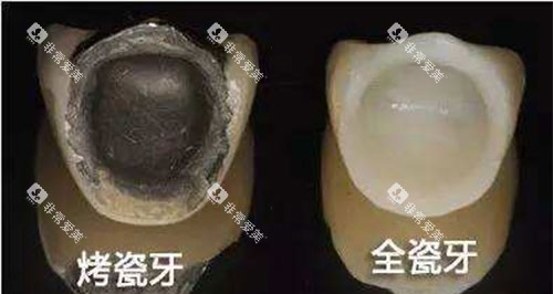 烤瓷牙和全瓷牙展示图