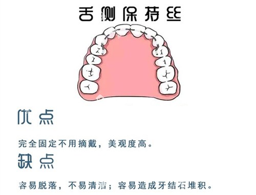 牙齿矫正舌侧保持器优缺点图
