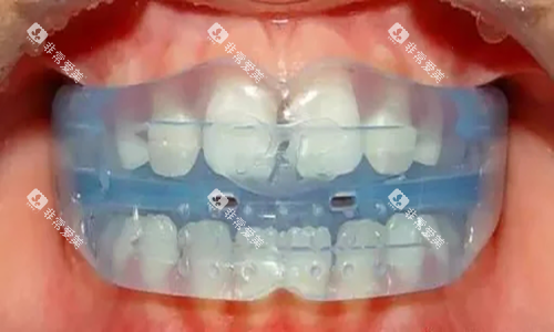 MRC儿童牙齿早期干预矫治器