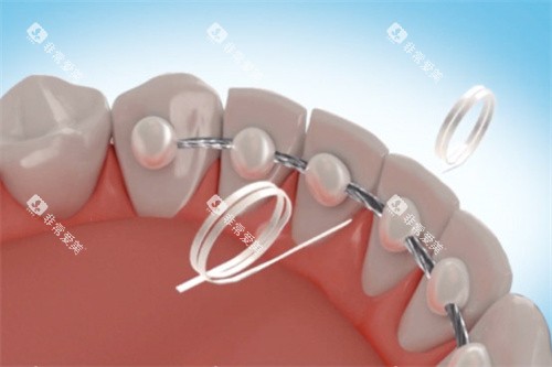 佩戴舌侧保持器后请假牙缝