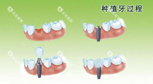 种植牙过程图片
