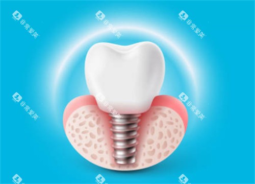 种植牙有光圈示意图
