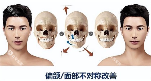 正颌手术原理与对比展示动画图