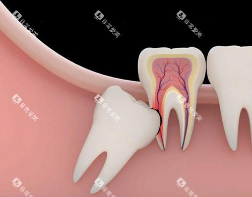 智齿漫画示意图