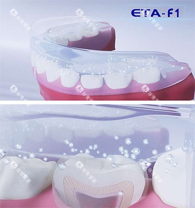 ETA牙齿矫正器